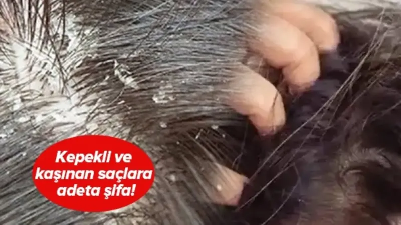 Kaşınan ve kepeklenen saçınız varsa dikkat! Bu yöntemlerle hem rahatlayacak hem de saçınızı uzatacaksınız